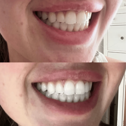 ✨Teeth Whitening Powder – Advanced PAP+ Formula for a Radiant, Healthy Smile