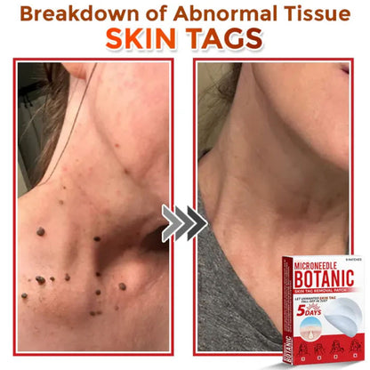 Skin Tag Removal Patches ✨(9PCS)
