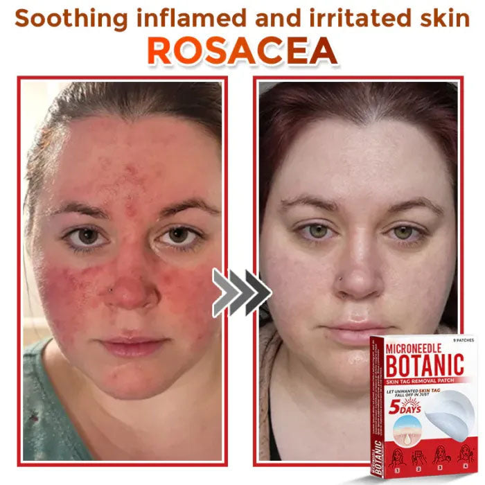Skin Tag Removal Patches ✨(9PCS)