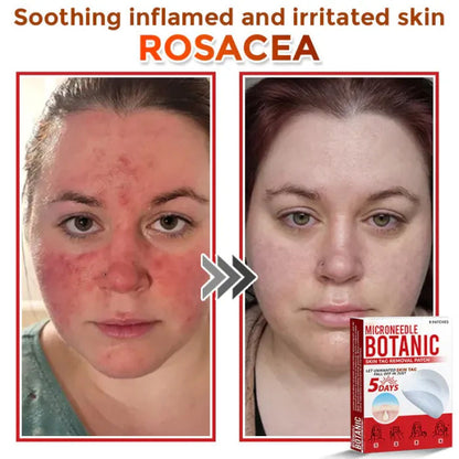 Skin Tag Removal Patches ✨(9PCS)