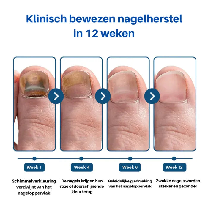 Laser behandelingvoor Schimmelnagels