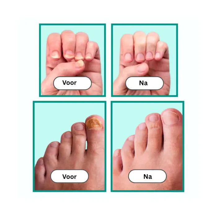 Laser behandelingvoor Schimmelnagels