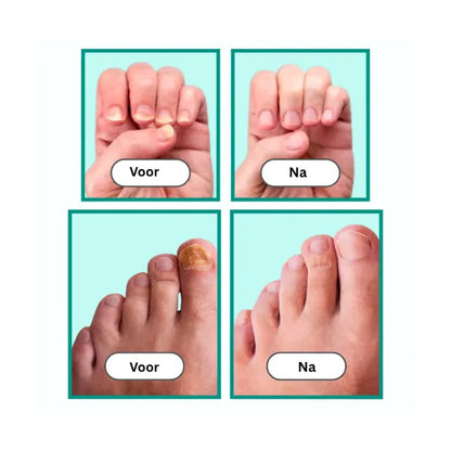 Laser behandelingvoor Schimmelnagels