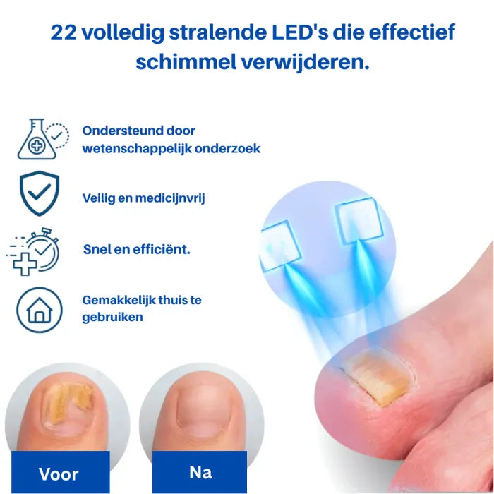 Laser behandelingvoor Schimmelnagels