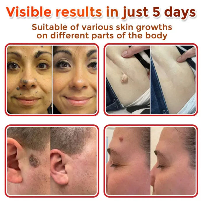 Skin Tag Removal Patches ✨(9PCS)