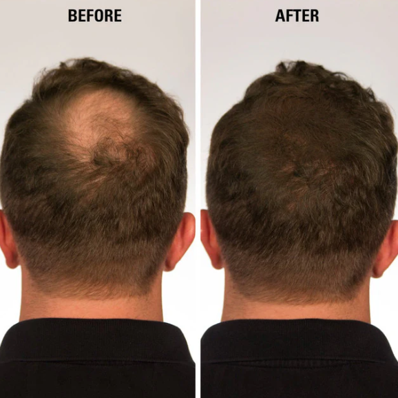 Natural Hair Regrowth Spray