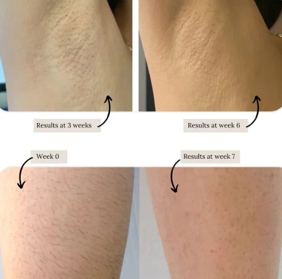 IPL Permanent Laser Hair Remover